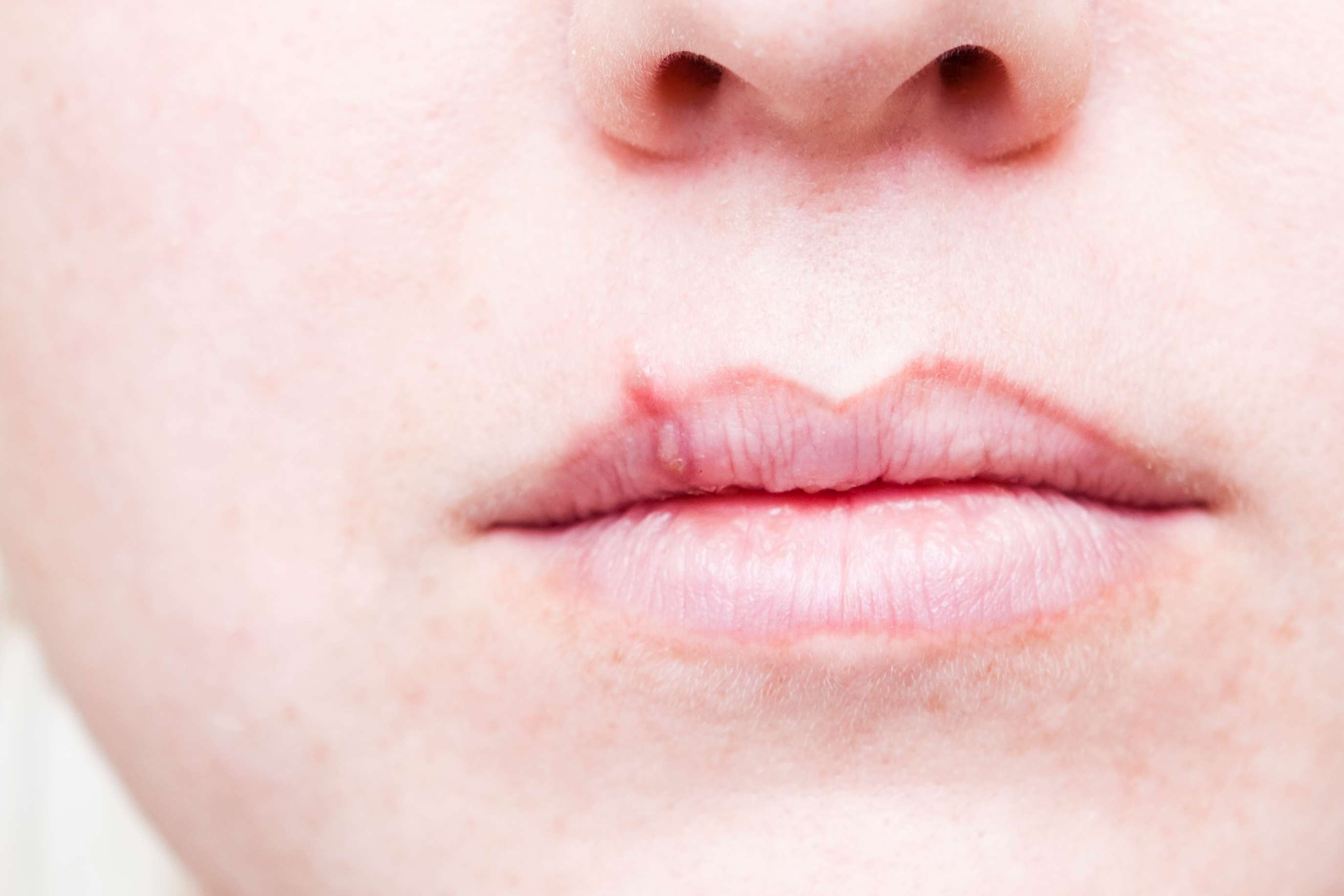 Cold sore on lip